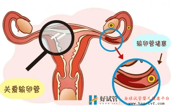 试管婴儿有哪些适应症(图1) 试管婴儿有哪些适应症(图1)